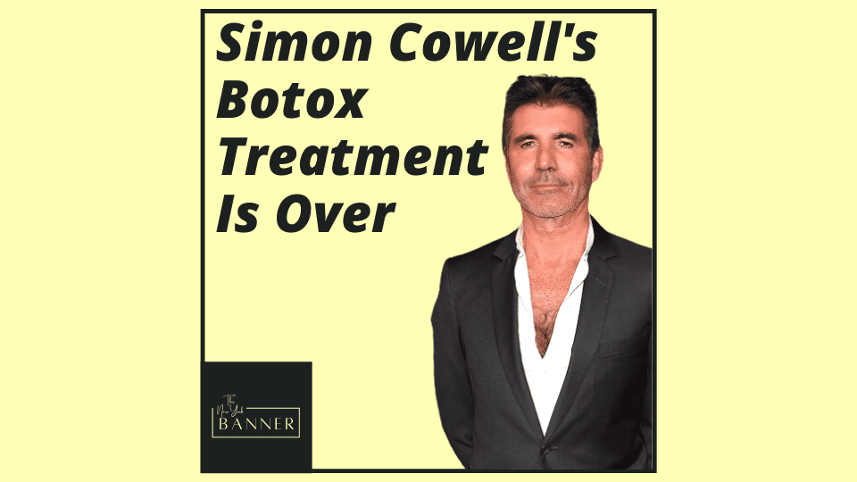 Simon Cowell's Botox Treatment Is Over